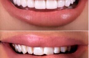 Cosmetic-Veneers-287x300