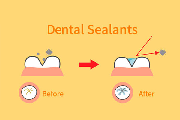 Sealants