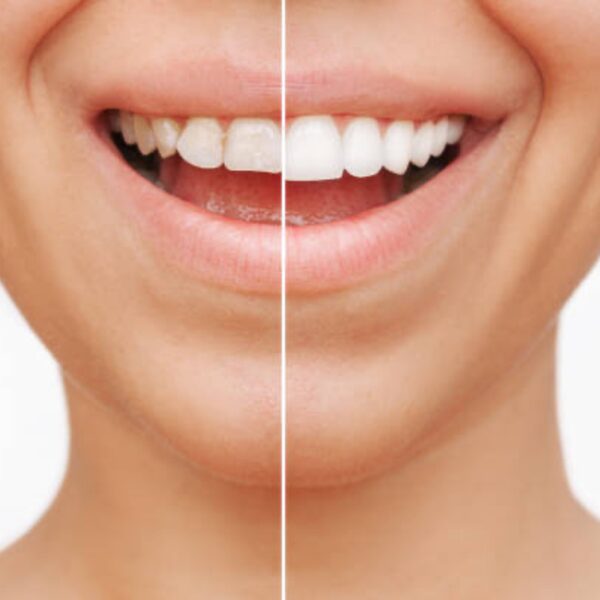 Veneers-2-600x600