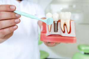 dental-implants-2-300x200