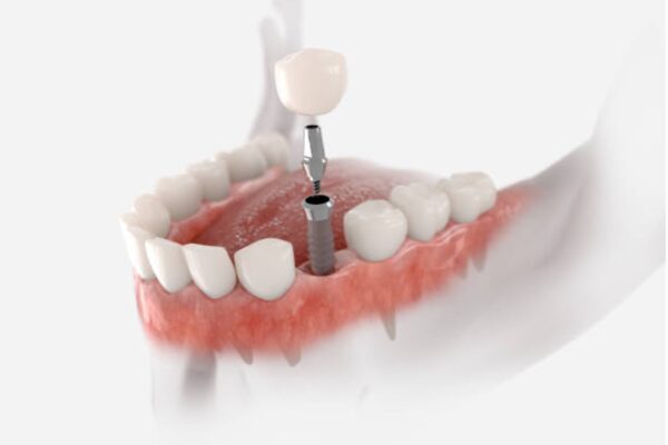 dental-implants-600x400